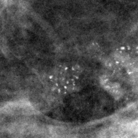 Mammogram Region of Interest